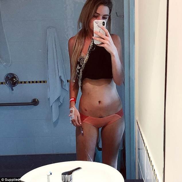 Μια 25χρονη δείχνει τι σημαίνει να έχεις κύστες στις ωοθήκες -Τα σημάδια στο κορμί της [βίντεο] | iefimerida.gr 2