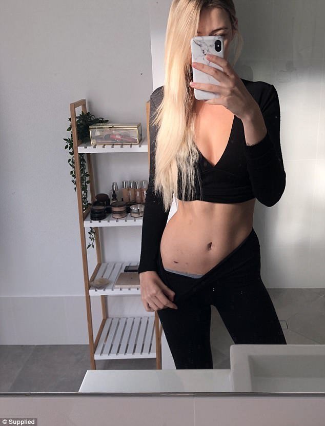 Μια 25χρονη δείχνει τι σημαίνει να έχεις κύστες στις ωοθήκες -Τα σημάδια στο κορμί της [βίντεο] | iefimerida.gr 4