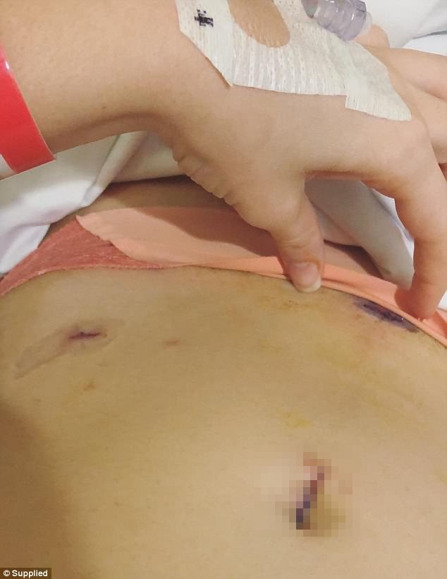 Μια 25χρονη δείχνει τι σημαίνει να έχεις κύστες στις ωοθήκες -Τα σημάδια στο κορμί της [βίντεο] | iefimerida.gr 3