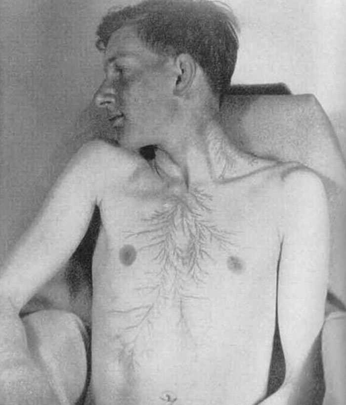 Ανθρωποι που τους χτύπησε κεραυνός δείχνουν τα μοναδικά σημάδια στο σώμα τους [εικόνες]  | iefimerida.gr 9