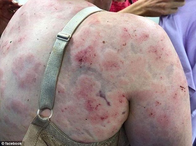 Η νεαρή μητέρα μετέβη γεμάτη μώλωπες στο νοσοκομείο διότι «χτυπήθηκε» από χοντρά κομμάτια πάγου στην προσπάθειά της να προστατέψει το μωρό της από χαλάζι.