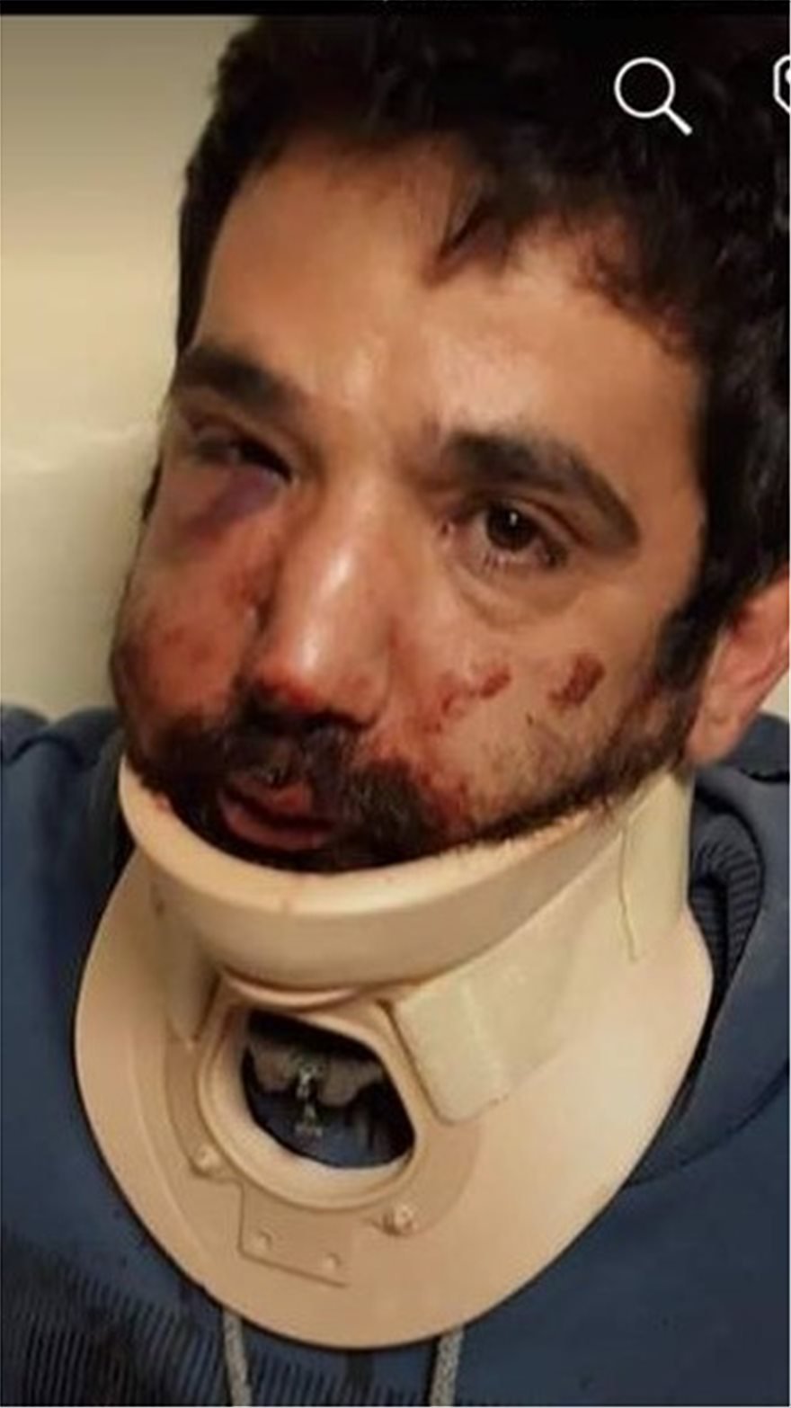 Ντελιβεράς καταγγέλλει ξυλοδαρμό από εργοδότη του -Τον χτύπησε με σιδερογροθιά στο πρόσωπο [εικόνα] | iefimerida.gr 0