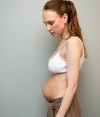 Μητέρα με τρίδυμα δείχνει ωμά πώς είναι η κοιλιά της μετά τη γέννα [εικόνες] | iefimerida.gr 3