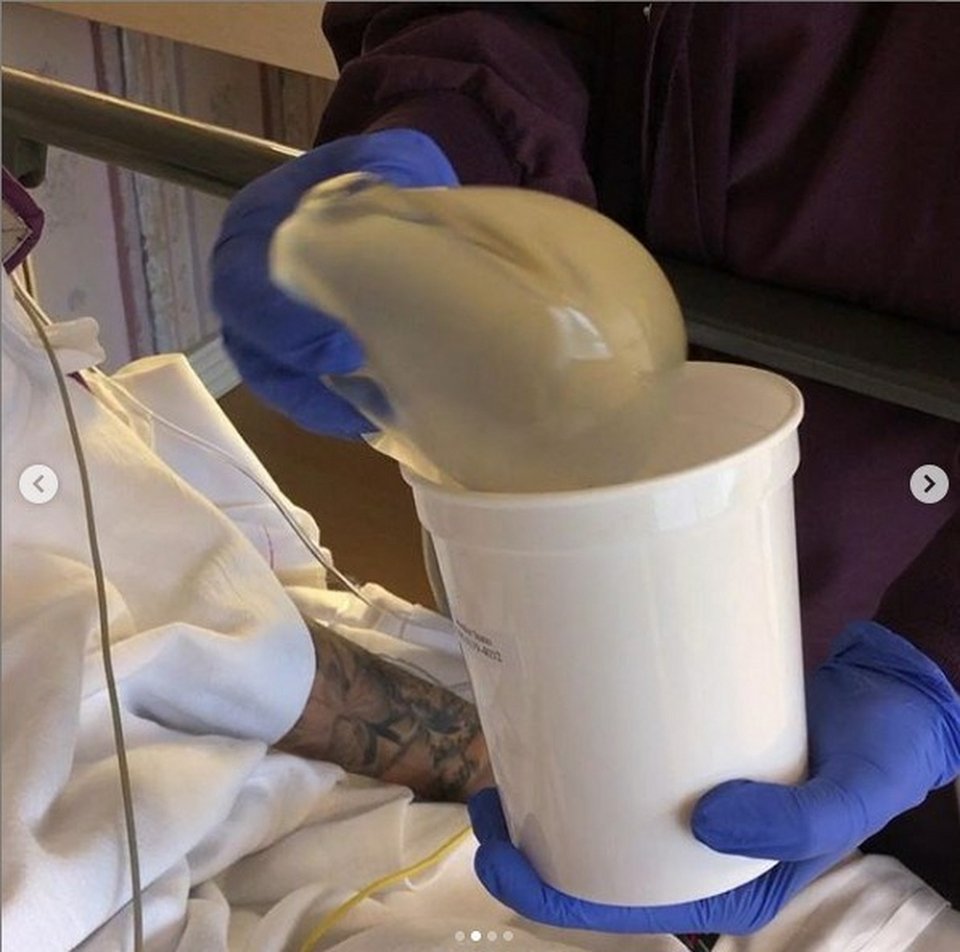 Η σεξοβόμβα πρώην του Αλκη Δαυίδ έβγαλε τη σιλικόνη από το στήθος και το έδειξε καρέ καρέ [εικόνες] | iefimerida.gr 1