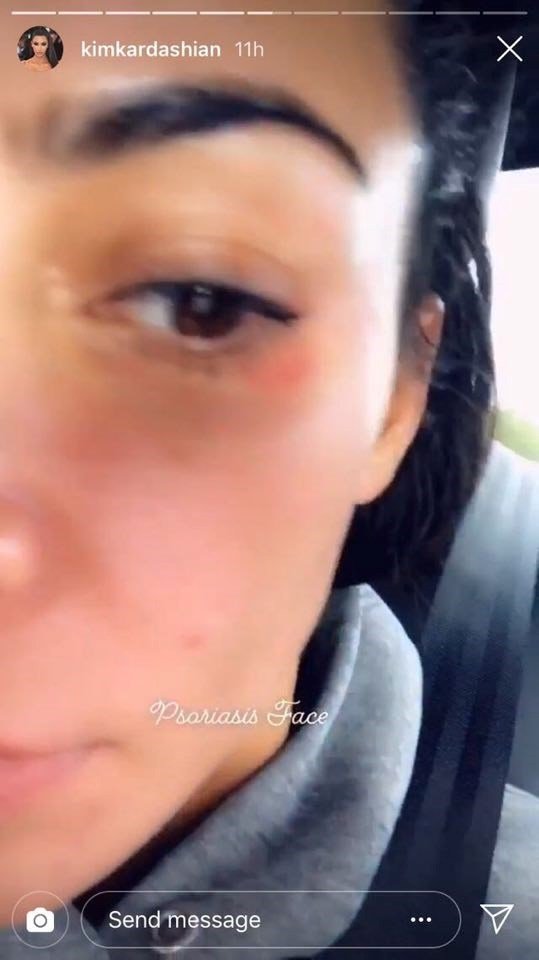 Τα κόκκινα σημάδια στο πρόσωπο της Κιμ Καρντάσιαν, εξαιτίας της ψωρίασης