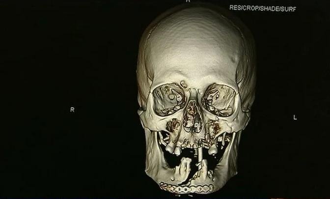 Φρικτό ατύχημα: Του έφυγε το αλυσοπρίονο και του έκοψε το πρόσωπο στη μέση [εικόνες]  | iefimerida.gr 0