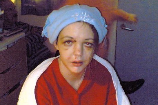 Σοκ: 35χρονη έχασε το μισό μέτωπό της σε τροχαίο -Είχε τα πόδια στο ταμπλό του αυτοκινήτου [εικόνες] | iefimerida.gr 3