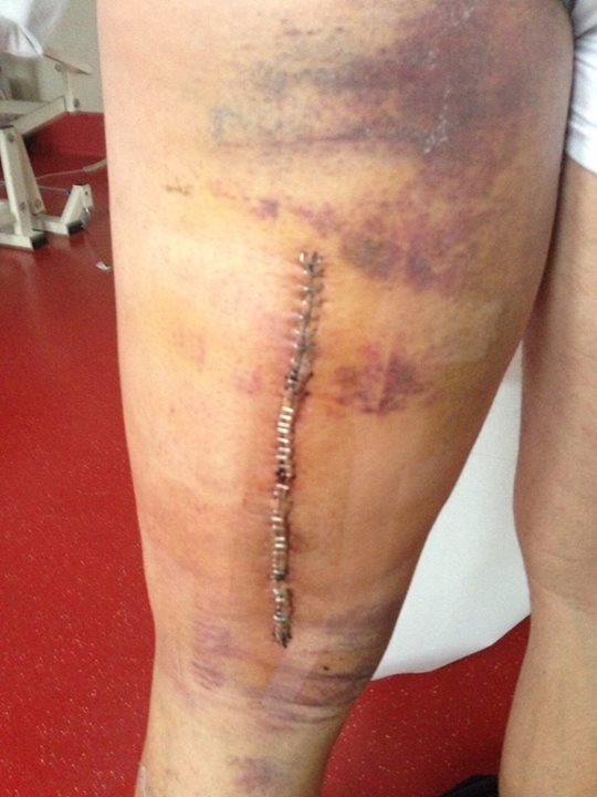 Σοκάρουν οι φωτογραφίες από τραυματισμό παίκτη της Γιουβέντους [εικόνες] | iefimerida.gr 0