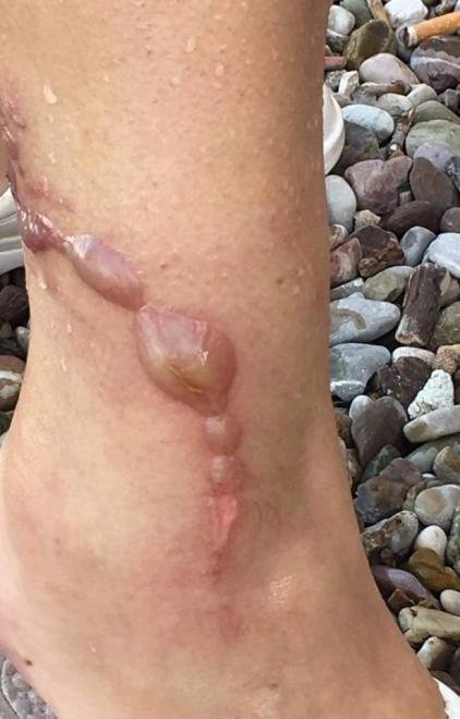 Πάτρα: Γυναίκα μεταφέρθηκε εσπευσμένα στο νοσοκομείο από τσίμπημα μέδουσας [εικόνες] | iefimerida.gr 1