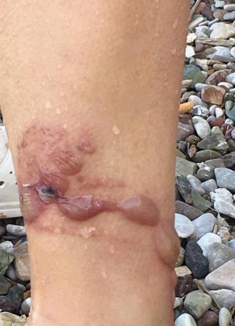 Πάτρα: Γυναίκα μεταφέρθηκε εσπευσμένα στο νοσοκομείο από τσίμπημα μέδουσας [εικόνες] | iefimerida.gr 0