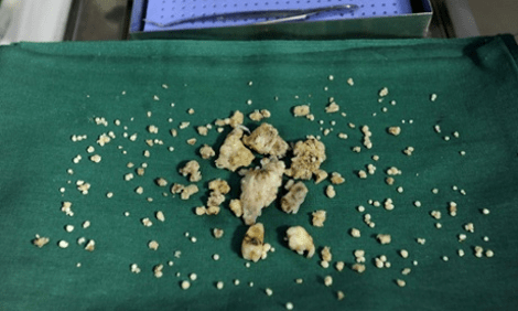 Απίστευτο: 17χρονος Ινδός είχε περίσσευμα 232 δόντια -Δεν πίστευαν στα μάτια τους οι γιατροί [εικόνες] | iefimerida.gr 1