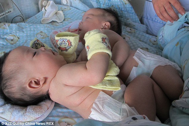 Καρέ καρέ ο διαχωρισμός σιαμαίων διδύμων στην Κίνα [εικόνες] | iefimerida.gr 2