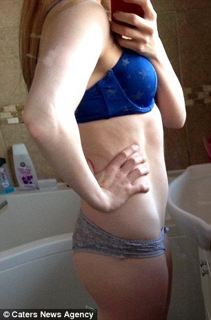 Ετσι είναι η ανορεξία: 15χρονη που ζύγιζε 30 κιλά δίνει στη δημοσιότητα τις φωτογραφίες της [εικόνες] | iefimerida.gr 6