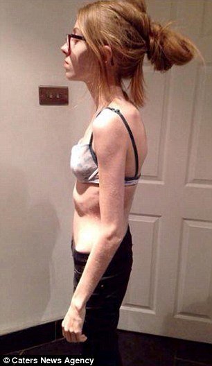 Ετσι είναι η ανορεξία: 15χρονη που ζύγιζε 30 κιλά δίνει στη δημοσιότητα τις φωτογραφίες της [εικόνες] | iefimerida.gr 2