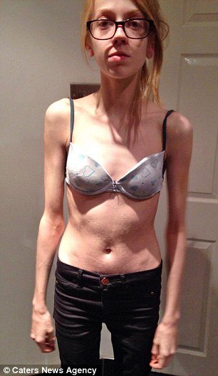 Ετσι είναι η ανορεξία: 15χρονη που ζύγιζε 30 κιλά δίνει στη δημοσιότητα τις φωτογραφίες της [εικόνες] | iefimerida.gr 1