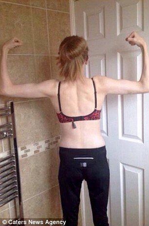 Ετσι είναι η ανορεξία: 15χρονη που ζύγιζε 30 κιλά δίνει στη δημοσιότητα τις φωτογραφίες της [εικόνες] | iefimerida.gr 3