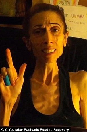 37χρονη με ανορεξία καταφέρνει να περπατήσει για πρώτη φορά μετά από μήνες [βίντεο] | iefimerida.gr 3