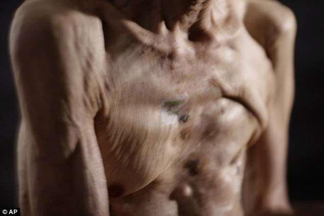 Τα σημάδια της ατομικής βόμβας - Επιζών δείχνει για πρώτη φορά τα εγκαύματά του [εικόνες] | iefimerida.gr 3