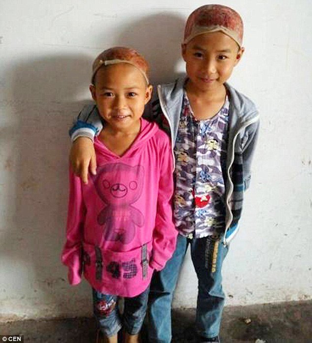 Μάθημα αγάπης στην Κίνα: Αδερφάκια έδωσαν δέρμα του κεφαλιού τους για να σώσουν τον πατέρα τους [εικόνες] | iefimerida.gr 2