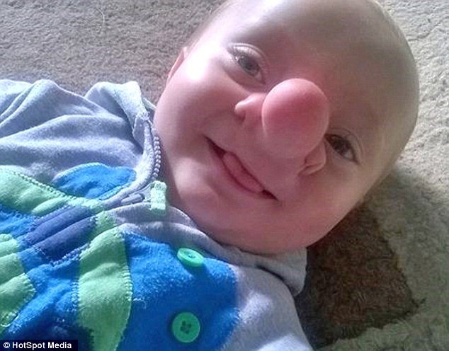 Το «παιδί-Πινόκιο» – Ο εγκέφαλός του μεγαλώνει στη μύτη του [εικόνες] | iefimerida.gr 4