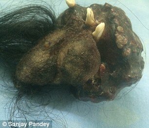 Σοκαριστικές εικόνες: Κουβαλούσε επί 18 χρόνια στο στομάχι του τον δίδυμο αδελφό του [εικόνες] | iefimerida.gr 1