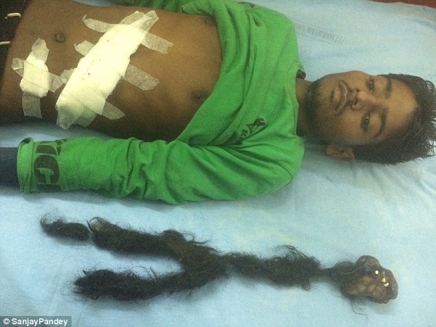 Σοκαριστικές εικόνες: Κουβαλούσε επί 18 χρόνια στο στομάχι του τον δίδυμο αδελφό του [εικόνες] | iefimerida.gr 2