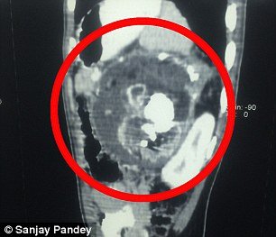 Σοκαριστικές εικόνες: Κουβαλούσε επί 18 χρόνια στο στομάχι του τον δίδυμο αδελφό του [εικόνες] | iefimerida.gr 3