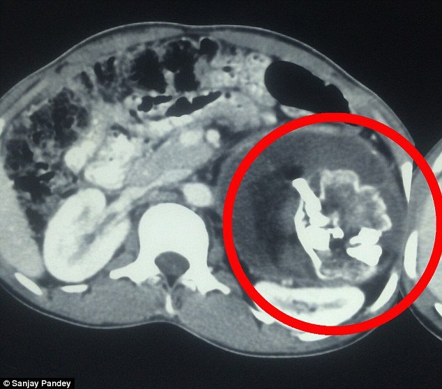 Σοκαριστικές εικόνες: Κουβαλούσε επί 18 χρόνια στο στομάχι του τον δίδυμο αδελφό του [εικόνες] | iefimerida.gr 4