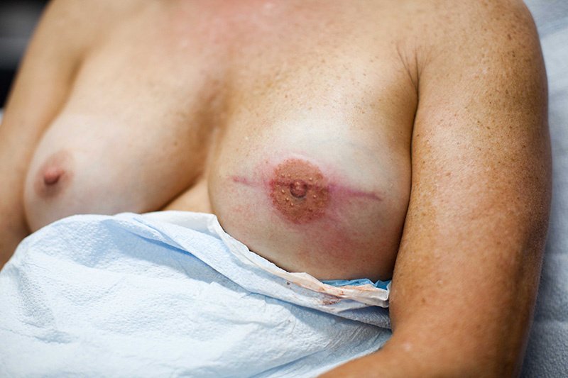 «Τατουατζής» αναπλάθει τις θηλές γυναικών που έχουν υποβληθεί σε μαστεκτομή [εικόνες] | iefimerida.gr 2