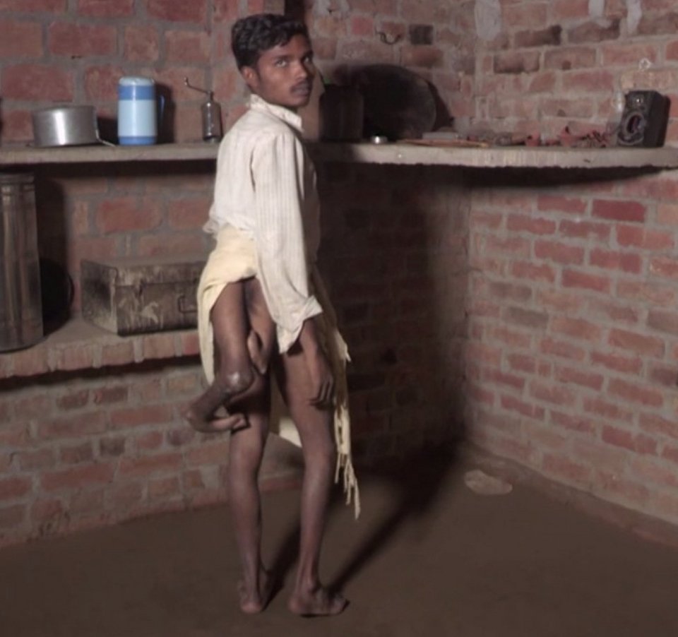 Ο Ινδός με τα τέσσερα πόδια -Κάνει έκκληση στους γιατρούς να του τα αφαιρέσουν [εικόνες & βίντεο] | iefimerida.gr 0