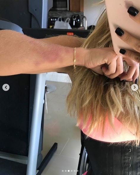 Μοντέλο ποστάρει φωτό με καψίματα από τσιγάρα, μελανιές -Τη χτυπούσε ο σύντροφός της [εικόνες] | iefimerida.gr 0