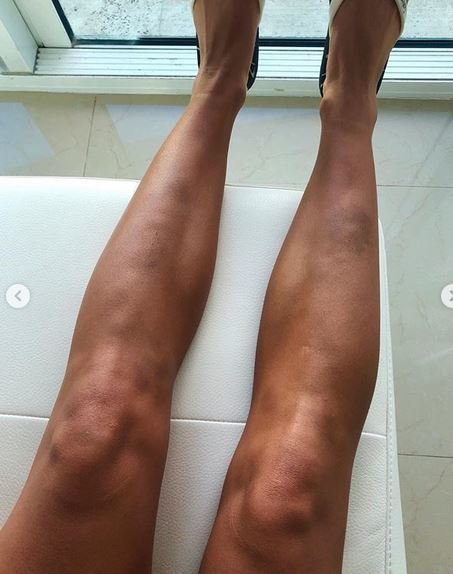 Μοντέλο ποστάρει φωτό με καψίματα από τσιγάρα, μελανιές -Τη χτυπούσε ο σύντροφός της [εικόνες] | iefimerida.gr 1