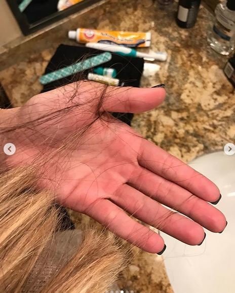 Μοντέλο ποστάρει φωτό με καψίματα από τσιγάρα, μελανιές -Τη χτυπούσε ο σύντροφός της [εικόνες] | iefimerida.gr 2