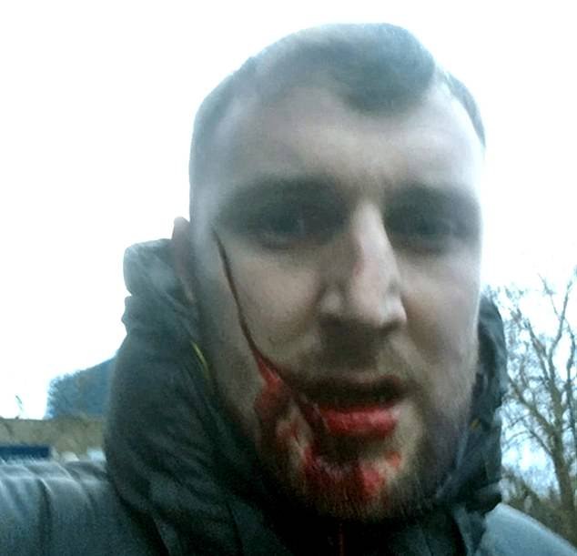 Σοκαριστικά επεισόδια: Μαχαιρωμένος στο πρόσωπο οπαδός της Εβερτον [εικόνες & βίντεο] | iefimerida.gr 0