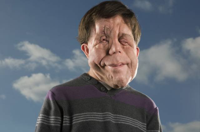 «Ανθρωπος ελέφαντας»: Οι σοκαριστικές αποκαλύψεις ενός άνδρα που πάσχει από μια σπάνια ασθένεια [εικόνες] | iefimerida.gr 0