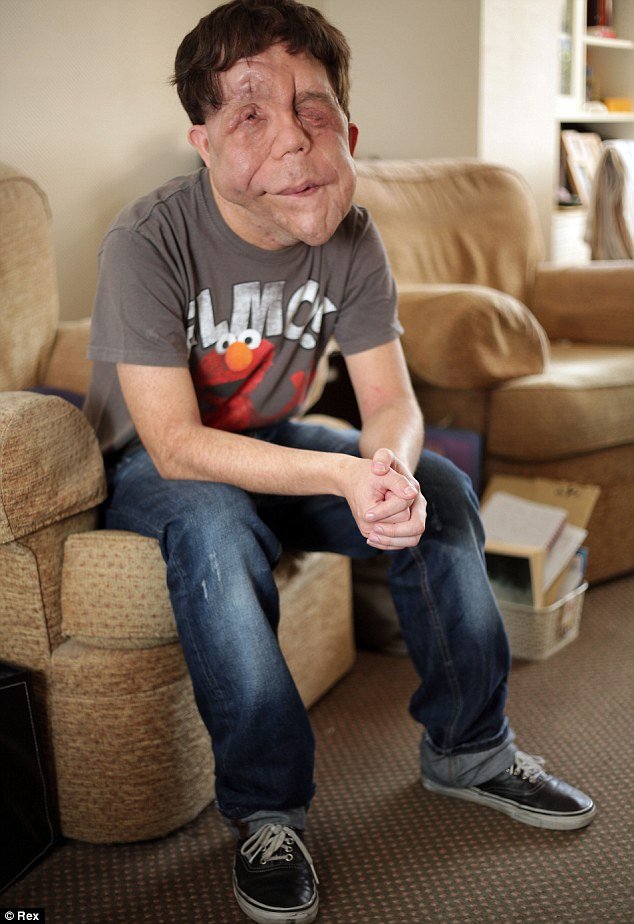 «Ανθρωπος ελέφαντας»: Οι σοκαριστικές αποκαλύψεις ενός άνδρα που πάσχει από μια σπάνια ασθένεια [εικόνες] | iefimerida.gr 2