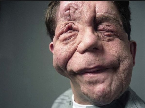 «Ανθρωπος ελέφαντας»: Οι σοκαριστικές αποκαλύψεις ενός άνδρα που πάσχει από μια σπάνια ασθένεια [εικόνες] | iefimerida.gr 3