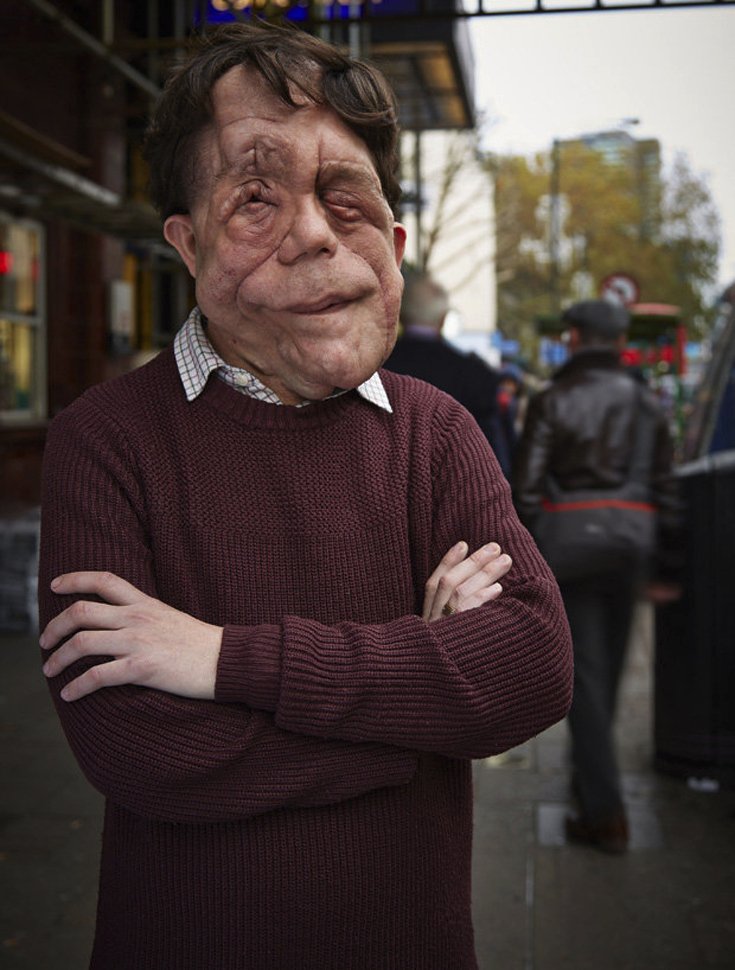 «Ανθρωπος ελέφαντας»: Οι σοκαριστικές αποκαλύψεις ενός άνδρα που πάσχει από μια σπάνια ασθένεια [εικόνες] | iefimerida.gr 4