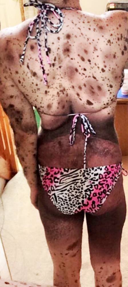 Η 19χρονη που το σώμα της είναι καλυμμένο κατά 70% με ελιές [εικόνες] | iefimerida.gr 1