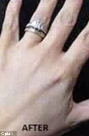 Η νέα παράλογη μανία: Κάνουν πλαστική στα χέρια για να βγάλουν selfies με το δαχτυλίδι των αρραβώνων τους [εικόνες]  | iefimerida.gr 0