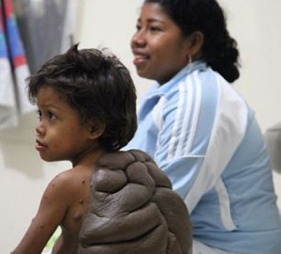 Οι γιατροί χάρισαν μια νέα ζωή στο «αγόρι - χελώνα» [εικόνες] | iefimerida.gr 3