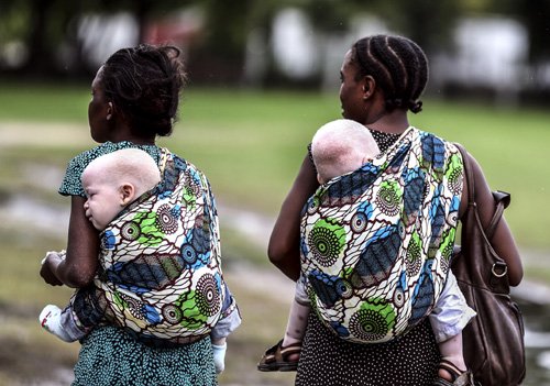 Εκοψαν το χέρι 6χρονου αλμπίνου στην Τανζανία -Κάνουν μαγεία ενόψει εκλογών [εικόνες] | iefimerida.gr 1