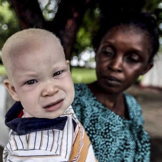 Εκοψαν το χέρι 6χρονου αλμπίνου στην Τανζανία -Κάνουν μαγεία ενόψει εκλογών [εικόνες] | iefimerida.gr 2