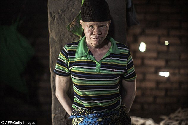 Τους σφάζουν όπου τους βρουν: Οι αλμπίνοι που ζουν με τον φόβο [εικόνες & βίντεο] | iefimerida.gr 0