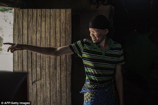 Τους σφάζουν όπου τους βρουν: Οι αλμπίνοι που ζουν με τον φόβο [εικόνες & βίντεο] | iefimerida.gr 1