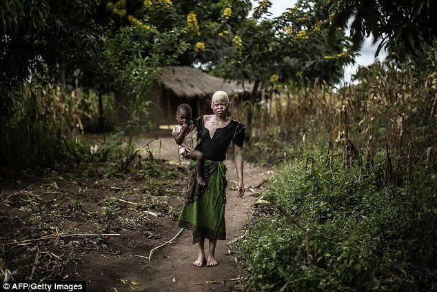 Τους σφάζουν όπου τους βρουν: Οι αλμπίνοι που ζουν με τον φόβο [εικόνες & βίντεο] | iefimerida.gr 7