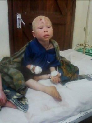 Εκοψαν το χέρι 6χρονου αλμπίνου στην Τανζανία -Κάνουν μαγεία ενόψει εκλογών [εικόνες] | iefimerida.gr 0