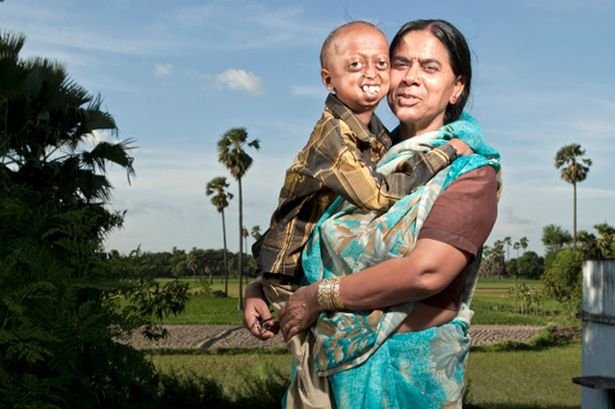14χρονο αγόρι στην Ινδία ζει στο σώμα ανθρώπου 110 ετών [εικόνες] | iefimerida.gr 0