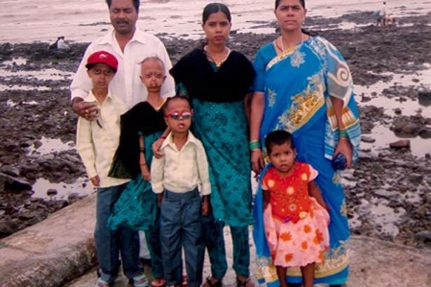 14χρονο αγόρι στην Ινδία ζει στο σώμα ανθρώπου 110 ετών [εικόνες] | iefimerida.gr 1