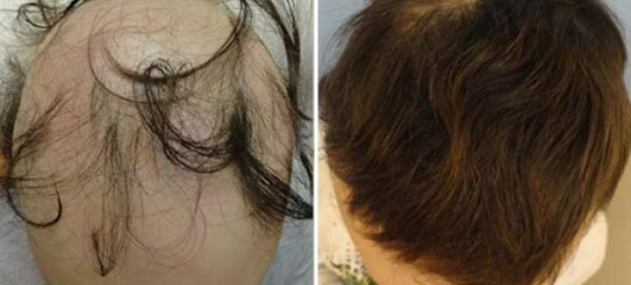 Γυροειδής Αλωπεκία: Ο πλαστικός χειρουργός Δρ Αναστάσιος Βεκρής εξηγεί πώς αντιμετωπίζεται | iefimerida.gr 0